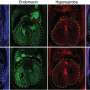 Gene in the abet of heart defects in Down syndrome recognized
