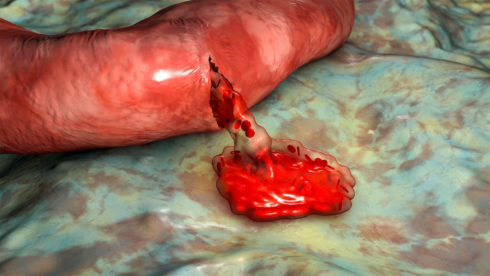 Concomitant SSRI and Oral Anticoagulant Expend Tied to Indispensable Bleeding Disaster